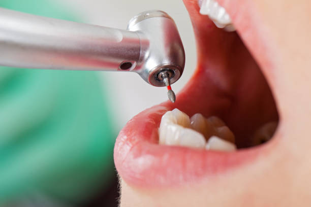 Best Knocked-Out Tooth (Avulsed Tooth) Treatment in Bayonet Point, FL